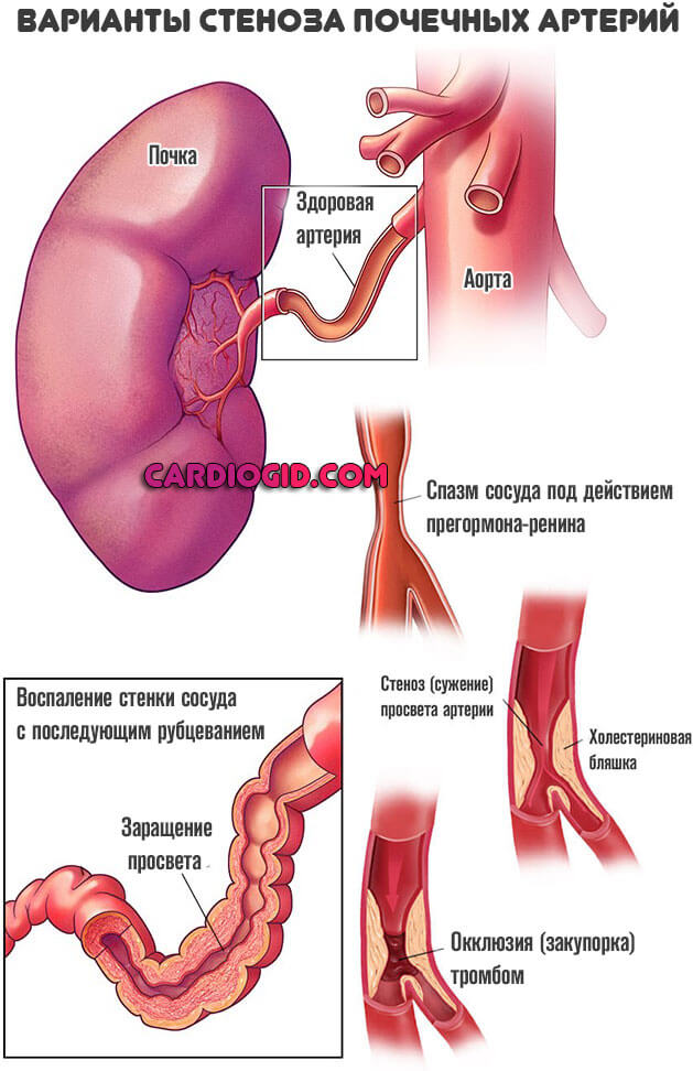 Что такое стеноз. Стеноз почечной артерии. Стент почечнрй артерии. Стеноз почечных сосудов. Стент в почечной артерии.